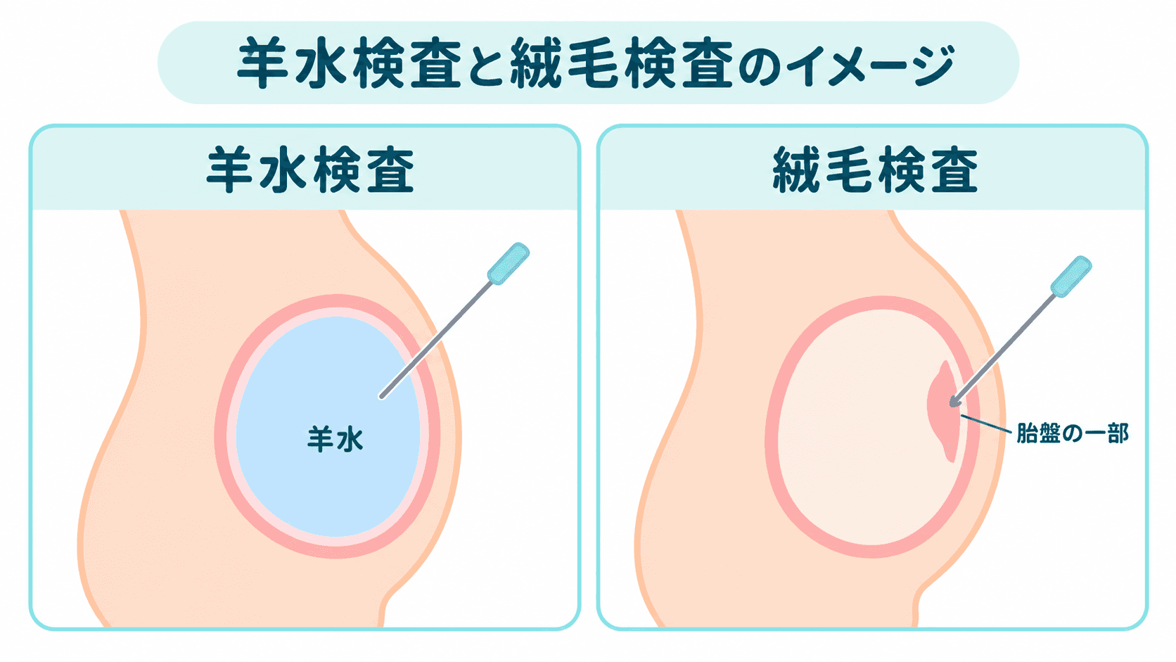 羊水検査と絨毛検査のイメージ:羊水検査はおなかに針を刺して羊水を採取し、絨毛検査は胎盤の一部を採取する