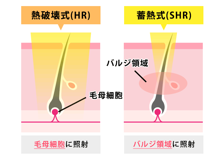 照射方式の違い