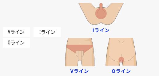 VIO脱毛の脱毛範囲